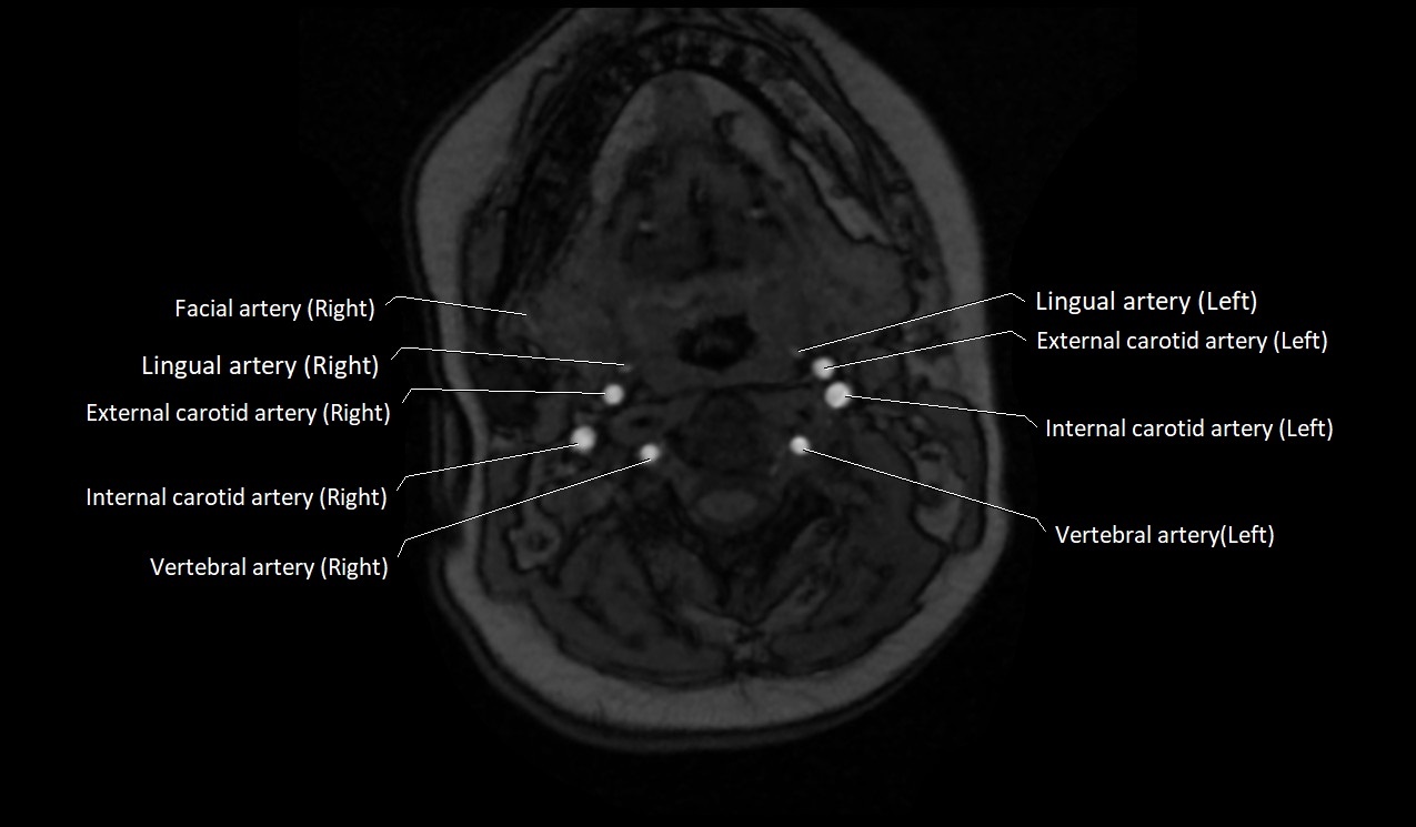 Carotid artery anatomy axial 3T image 23.jpg